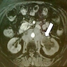 Gadolinium enhanced MRI Renal Pelvis