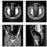 CT Bladder