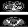 CT Ureter