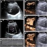 US Bladder