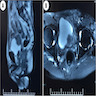 MRI Bladder