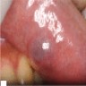 1.2 cm upper lip nodule