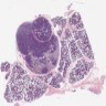 Acinic cell carcinoma, parotid