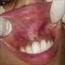 Oral swelling / tumefaction / lesion