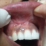 Oral lesion after resection, postresection zone
