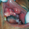 Oral nodule