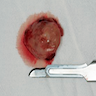 Resected nodule