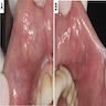 Oral nodules / lesions