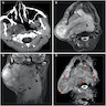 MRI of heterogeneous mass lesion