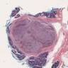 42M secretory carcinoma parotid