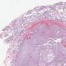 33F secretory carcinoma parotid