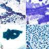 FNA cytology of secretory carcinoma