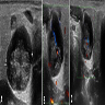 Ultrasound