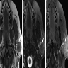 MRI
