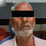 Extraoral facial asymmetry