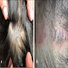 Bluish, ill defined lesion on the scalp