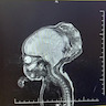 MRI appearance of NCH