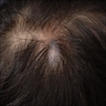 Gray-blue scalp lesion