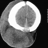 CT showing a scalp lesion