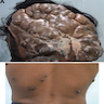 Cerebriform swelling with alopecia and multiple bluish firm nodules over the back