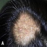 Multiple erythematous tan-brown papules and plaque on the scalp
