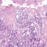 Ductal and cystic structures in dermis