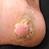 Skin colored, pedunculated firm nodule protruding from right heel toward sole