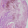 Proliferating fibroblasts and capillaries