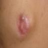 Atrophy and scarring on surface