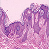 Typical histologic features of hyperkeratosis, acanthosis and papillomatosis