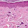 Stromal cells have atypical nuclei