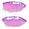 Acute spongiotic dermatitis