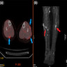 Nodular amyloidosis (PET)