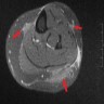 Nodular amyloidosis (MRI)