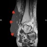 Nodular amyloidosis (MRI)
