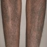 Lichen amyloidosis - symmetric hyperpigmented macules