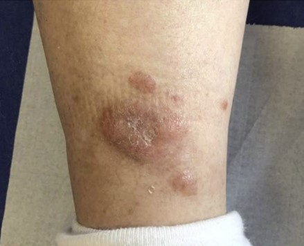 Nodular amyloidosis, pink-brown nodules