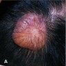Nodular amyloidosis salmon colored waxy nodule 
