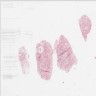 Nodular amyloidosis