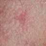 Erythematous papules and pustules resembling acne