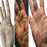 Erythema multiforme