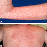 Acute GVHD