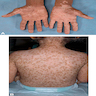 Chronic GVHD