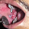 Erosive oral lichen planus