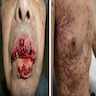 Lichen planus-like drug eruption