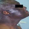 Lichenoid photodermatitis