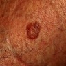 Lichen planus-like keratosis
