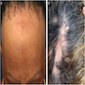 Frontotemporal and eyebrow alopecia (FFA) and Multifocal scalp alopecia (LPP)