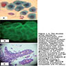 Large round acantholytic cells