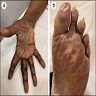 Punctate porokeratosis of palms and soles